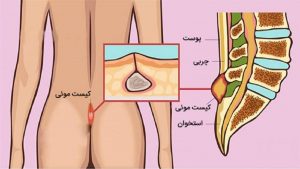 دلایل بروز کیست مویی