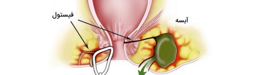 علت بروز آبسه