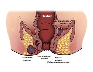 درمان آبسه مقعد