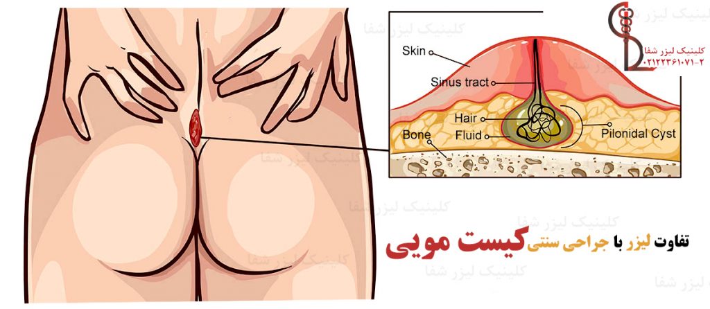 تفاوت جراحی سنتی با لیزر کیست مویی