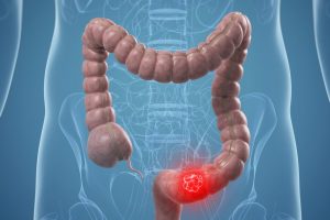 کرون و سرطان روده از دلایل بروز شقاق