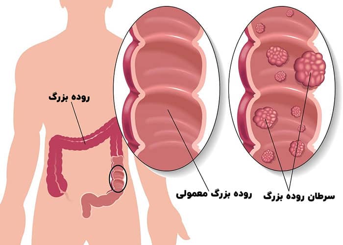 افتادگی جزیی روده