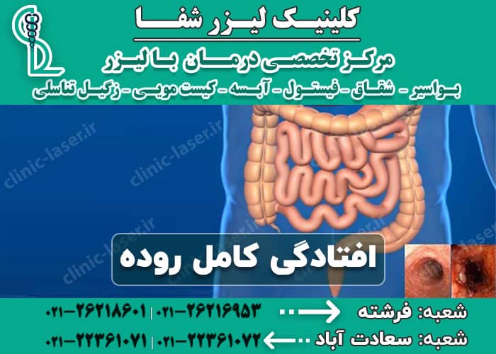 افتادگی کامل روده